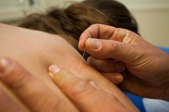 Dry Needling Therapie Nieuwegein & Utrecht